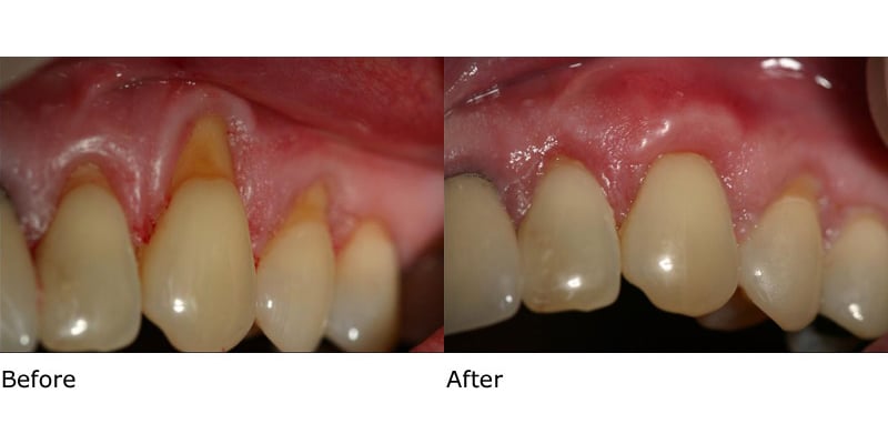 Before and after gum grafting
