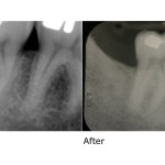 X-rays of before and after bone regeneration surgery