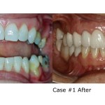 Before and after replacing a missing tooth