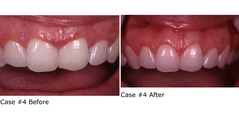Before and after fixing crooked teeth