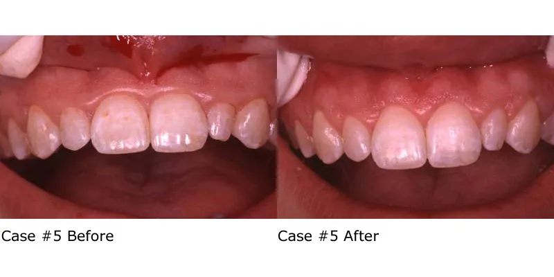 Before and after removal of excess gum