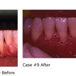 Before and after gum grafting