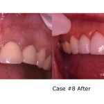 Before and after removal of excess gum