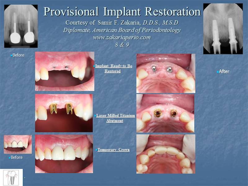 Before and after provisional implant restoration