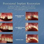 Before and after provisional implant restoration