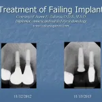 Before and after treatment of a failing implant