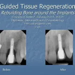 Before and after guided tissue regeneration