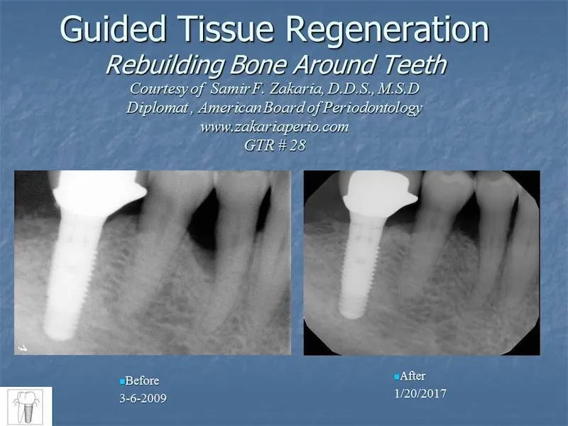 Before and after guided tissue regeneration