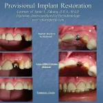before and after provisional implant placement