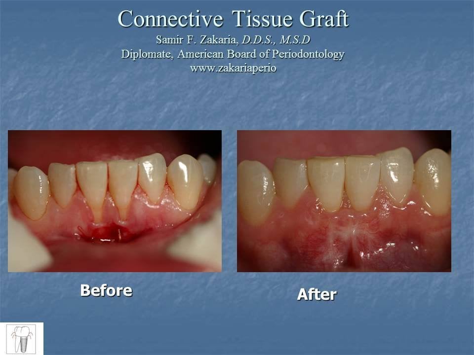 before and after gum grafting