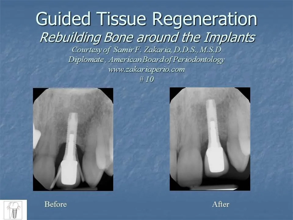 guided tissue regeneration before and after