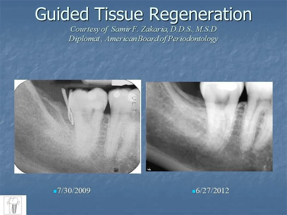 guided tissue regeneration before and after