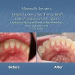 before and after gum grafting