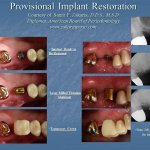 before and after provisional implant placement