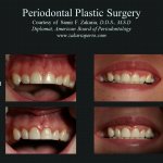 Before and After Periodontal Plastic Surgery