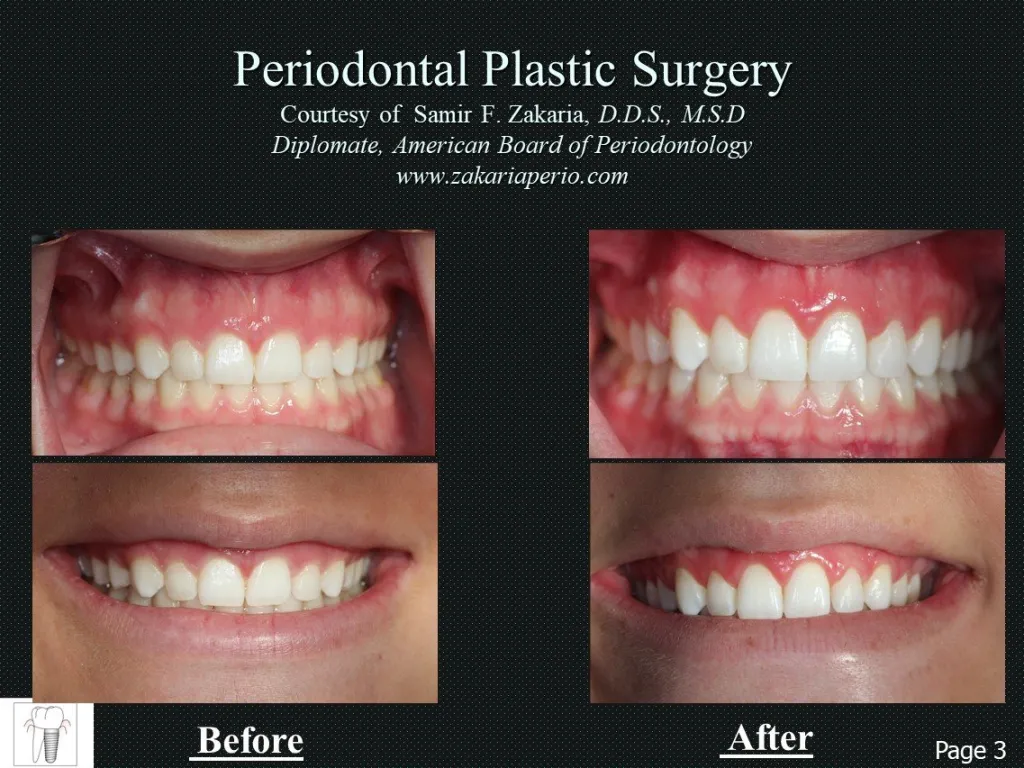Before and After Periodontal Plastic Surgery